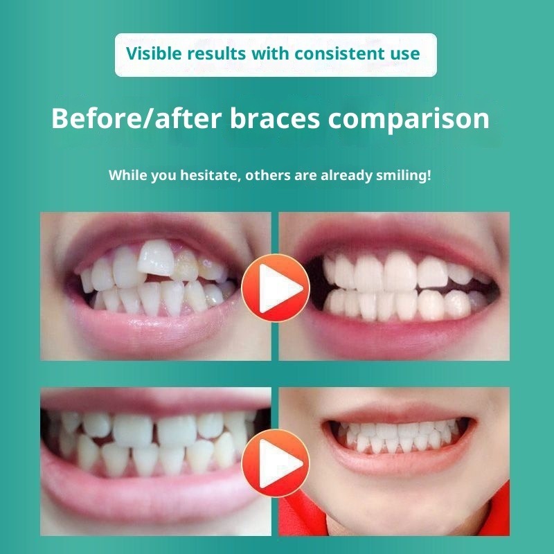 Soft Mouthguard for Teeth Grinding & Jaw Support